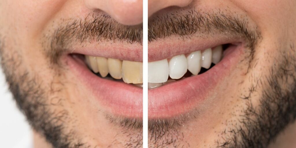 frecuencia del blanqueamiento dental