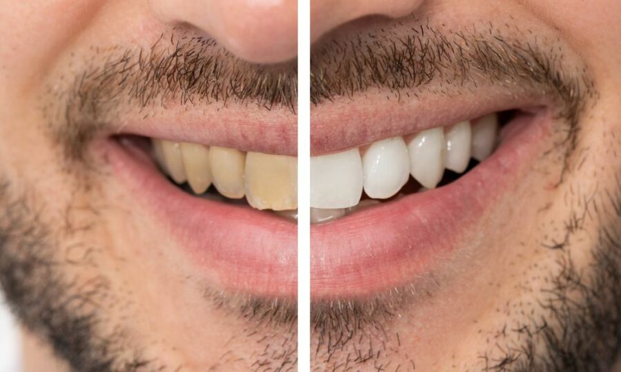 frecuencia del blanqueamiento dental