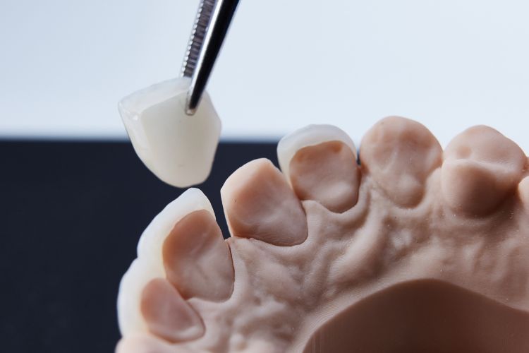 corona dental