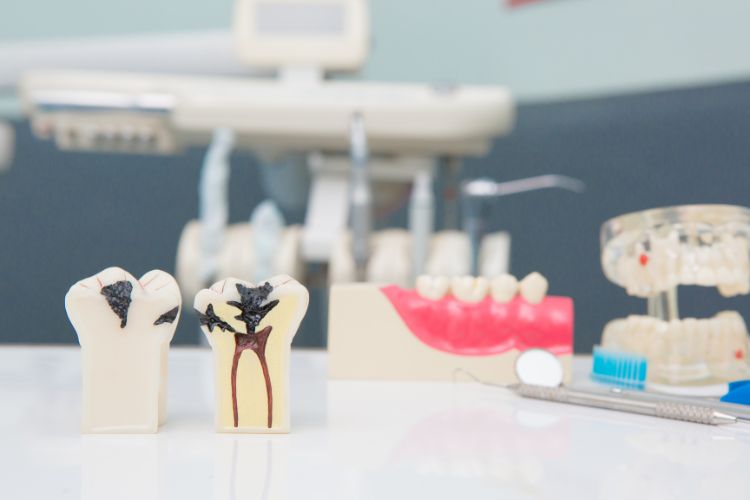 endodoncia dental