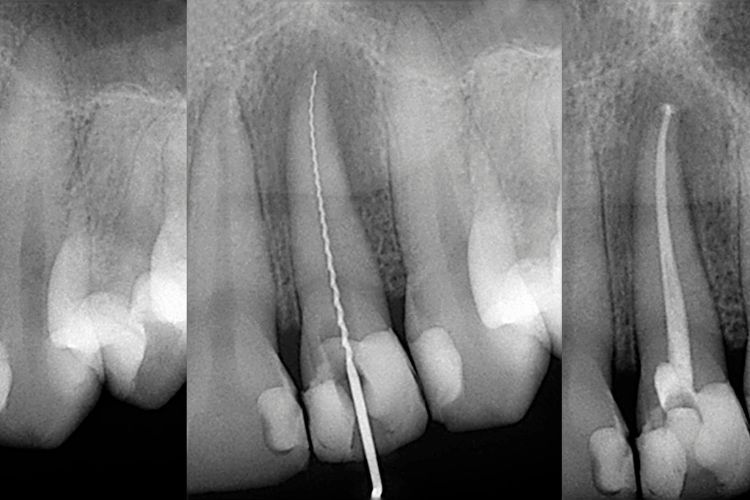 antes y despues endodoncia
