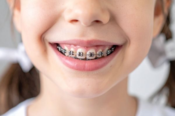 ortodoncia-infantil