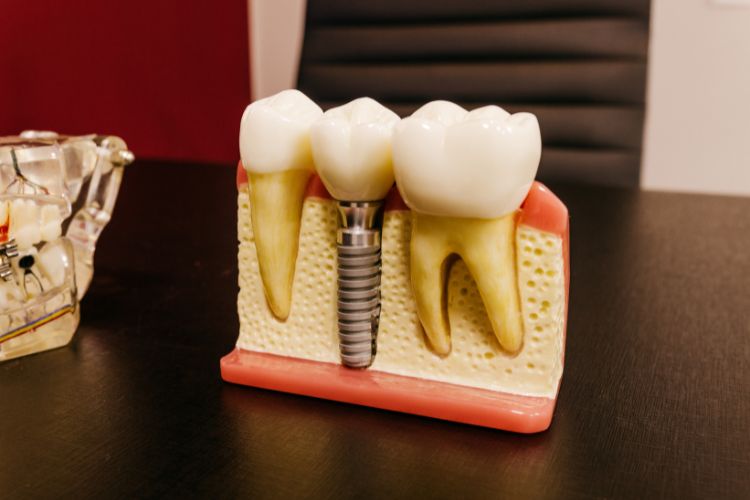 implantes dentales maqueta