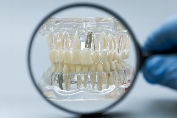 implantes dentales con tornillos
