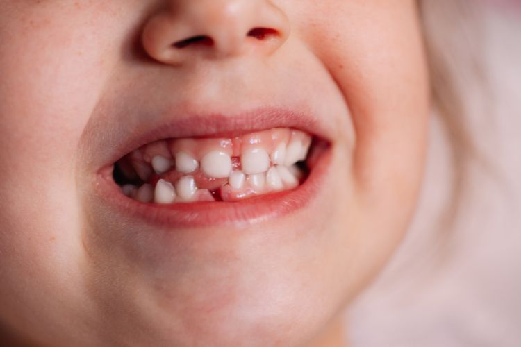 niño con dientes de abajo caídos