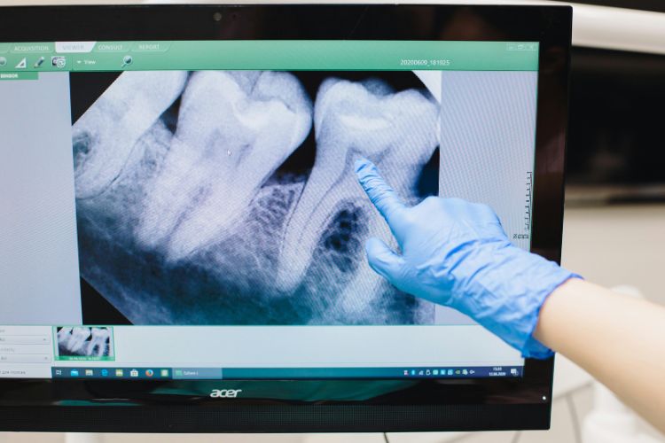 señalar diente en una radiografía dental
